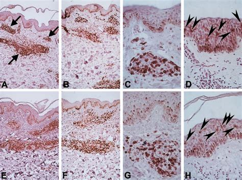 Figure 1 from Local nerve damage in leprosy does not lead to an ...