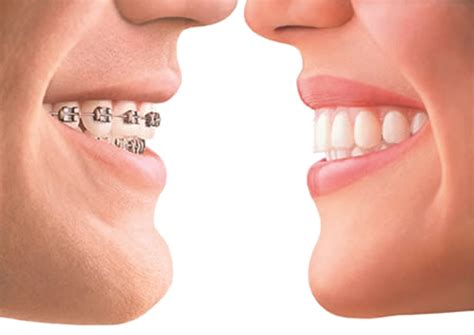 Royal Bahrain Hospital: Invisible Braces? Yes, please!