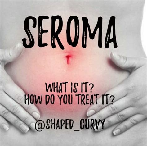 Seroma – Shaped Curvy