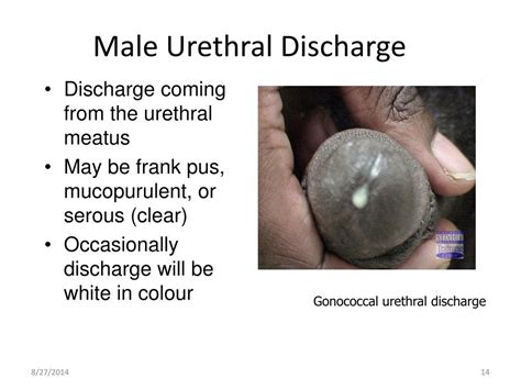 Urinary Tract Infection Men Discharge