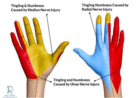 Radial Nerve:Course,Motor,Sensory & Common Injuries » How To Relief