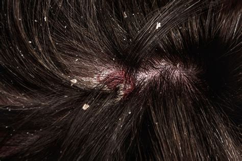 Dandruff Specialist Doctor | Dandruff Treatment in Lahore | Karachi & Islamabad