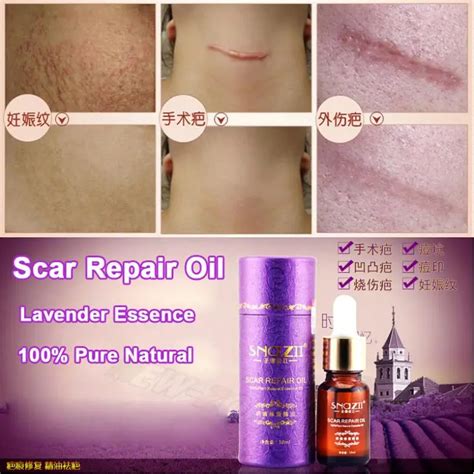 Scar Repair Oil Lavender Essence 100% Natural Pure Remove Ance Burn Stretch Marks Scar Removal ...