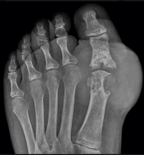 gout xray of the foot big toe joint - OC Podiatry