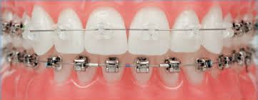 Ceramic Braces vs Metal Braces - Braces or Invisalign