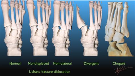 Midfoot Fracture-dislocations | UW Emergency Radiology