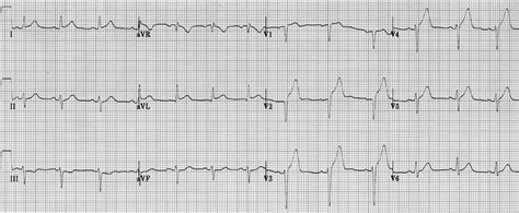 Anterior Myocardial Infarction • LITFL • ECG Library Diagnosis