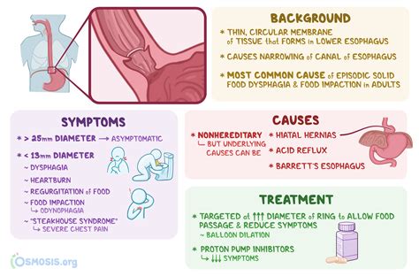 Schatzki Ring: What Is It, Causes, Treatment, and More | Osmosis