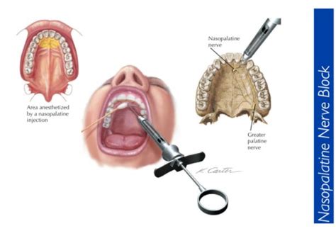 Nasopalatine nerve block Technique – Local Anesthesia