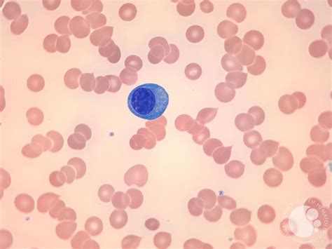 Plasma cell leukemia 1