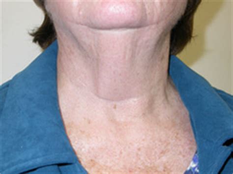 Scar After Thyroid Surgery. Minimally Invasive Thyroid Surgery, Alexander Shifrin, MD | www ...