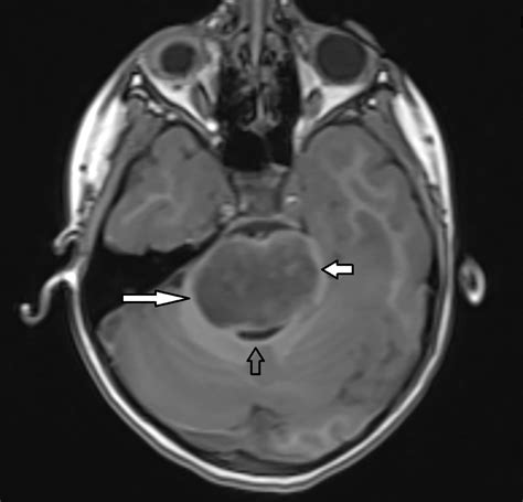 Diffuse intrinsic pontine glioma: DIPG | Radiology Key