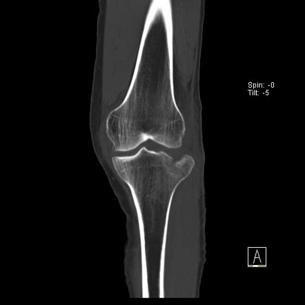 Schatzker Fracture Classification