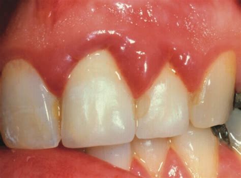 Gingivitis - Causes, Symptoms, Treatments, Hyperplasia, Pictures | Health9