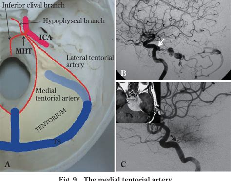 Figure 2 from Microsurgical Anatomy and Surgical Procedures for the Tentorial Incisura ...