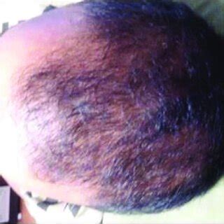 Androgenetic alopecia in patient before treatment. | Download ...