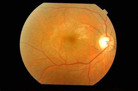 Inherited Cystoid Macular Edema - Retina Image Bank