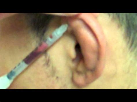 Cauliflower Ear Drain - YouTube