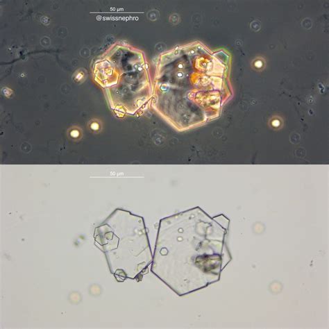 Urine Sediment of the Month: Cystine Crystals - Renal Fellow Network