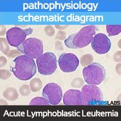 Acute Lymphoblastic Leukemia Pathophysiology & Schematic Diagram