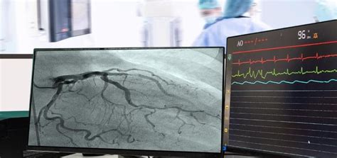 Angiography Vs Angiogram Vs Angioplasty. Know all about it. - PlanMyMedical