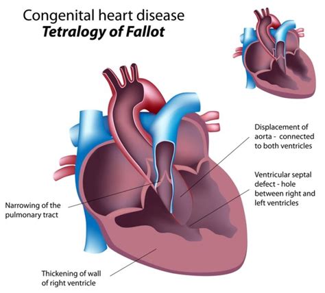 Congenital Heart Disease: How It Can Affect Us in Adulthood ...