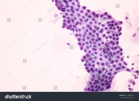 Normal Endocervical Cells Squamous Epithelial Cells Stock Photo ...