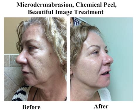 Microdermabrasion in Raleigh NC, Microdermabrasion Raleigh NC | Skin Essence A Day SpaSkin ...