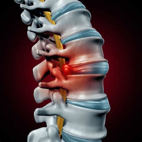 Herniated Disk - Causes, Symptoms, Exercises, Surgery, Treatment