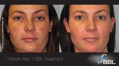 ablative laser resurfacing near me - Brigitte Charles