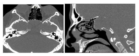 Brain CT scan showing (A) 3.7 cm large mass involving the sella turcica... | Download Scientific ...