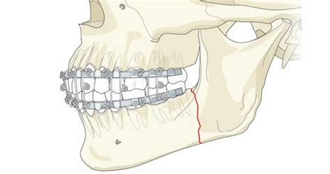 Best Orthognathic Surgeon Near You in Indore | Jaw Surgery