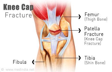 Fracture of Knee Cap - Causes - Symptoms - Diagnosis - Treatment - FAQs