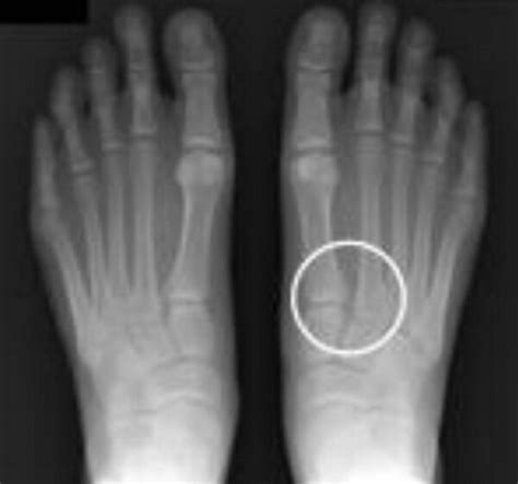 How to Recognise Midfoot Sprain and Lisfranc injury - Sport Doctor London