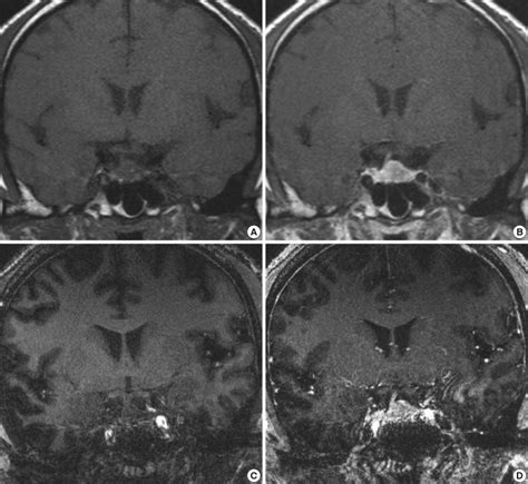 1.5T and 7.0T MRI for pituitary adenoma. The pre- and post-contrast... | Download Scientific Diagram