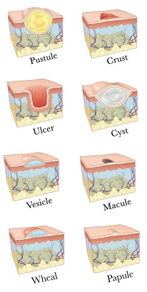 Let's Talk Lesions — Retief Skin Center | Nashville's Best ...