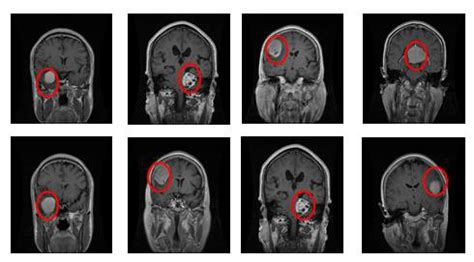 Collection of 8 glioma brain tumor MRI images from Dataset-B Fig.4 ...