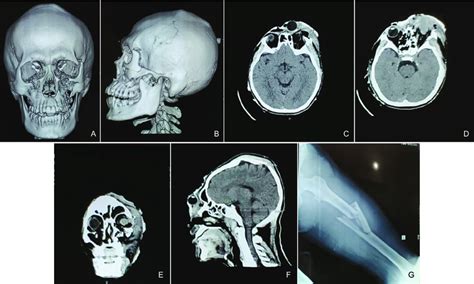 (A)-(B) CT scan 3D reconstruction found RLE blow out fracture, right ...