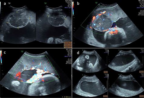 Giant Placental Chorangioma and Severe Ductal Arch Constriction: A Case ...