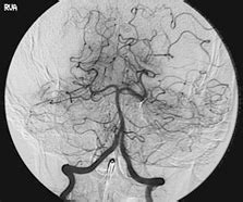 MIVIR Cerebral Angiogram Procedure Melbourne | MIVIR