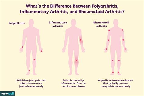 Inflammatory Polyarthropathy, Inflammatory Arthritis, and Rheumatoid ...