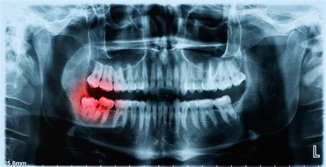 Broken Wisdom Tooth - what you must know - West Hollywood Holistic and ...