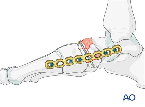 Temporary bridging of talonavicular joint for Complete articular ...