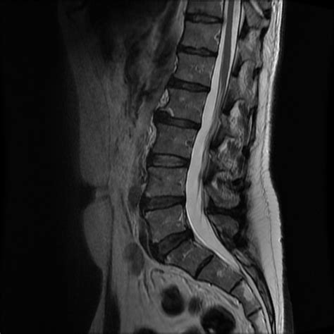 Lumbar Spine Mri Bulging Disc