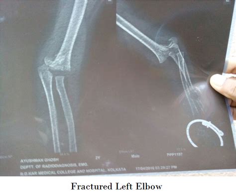 fractured-left-elbow