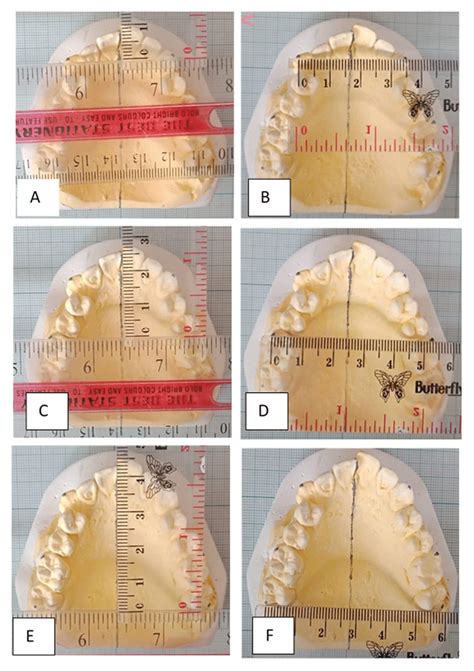 Differences in dental arch characteristics... | F1000Research