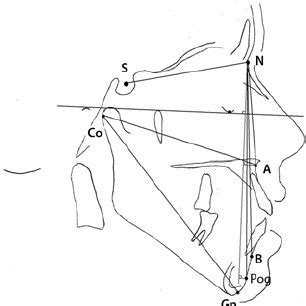 (PDF) Comparison of lateral photographic and radiographic sagittal analysis in relation to Angle ...