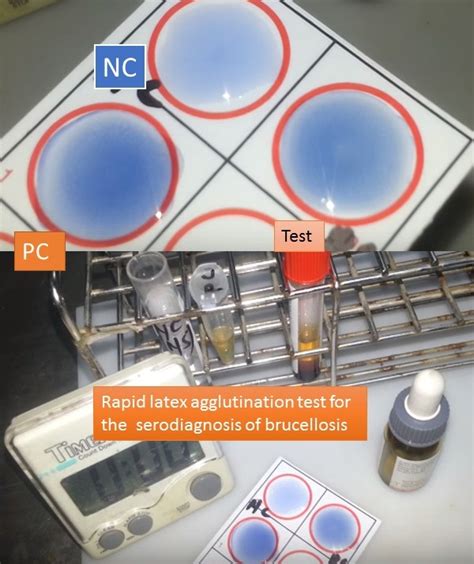 Brucella Agglutination test: Principle, Procedure and Result Interpretation