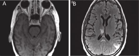 MRI brain showing leptomeningeal disease. (a) T1 axial MRI with ...