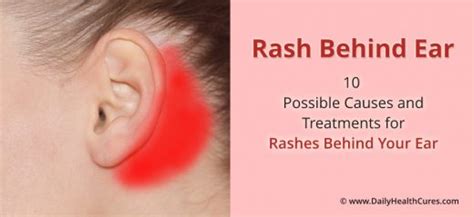 Rash behind Ear: 10 Possible Causes and Natural Treatments